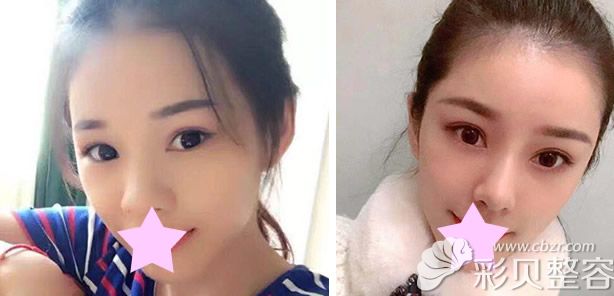 杭州格莱美整形肋软骨隆鼻效果对比图
