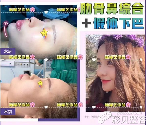 长沙韩美陈柳艺医生自体肋软骨综合隆鼻+假体垫下巴效果案例