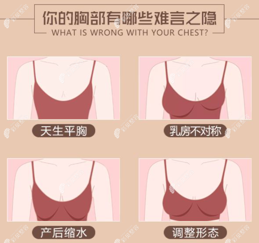 傲诺拉璀璨330cc水滴型假体隆胸术后一个月感受分享